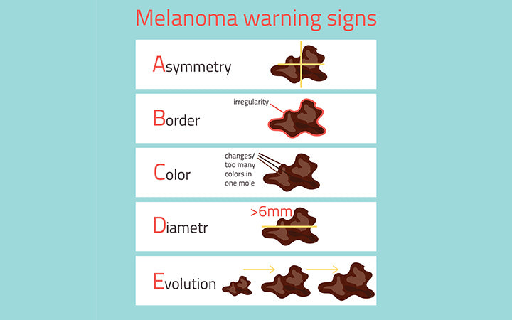 melanoma-warning-signs