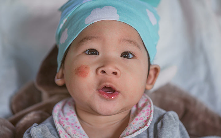 pityriasis alba on babys face atopic