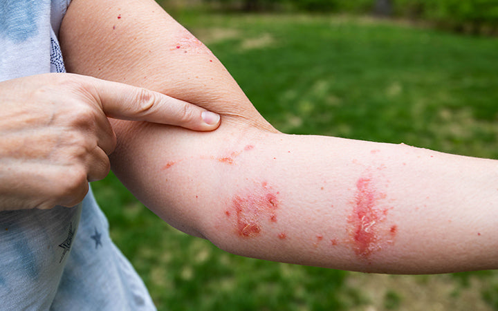 pointing at poison oak rash and infection with blisters