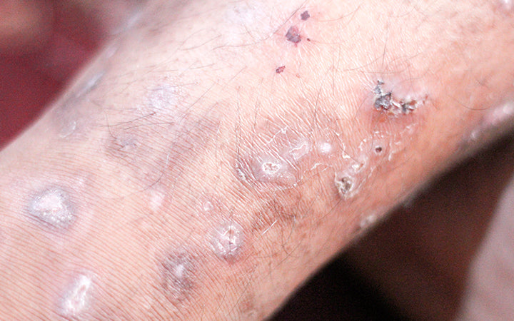 scabies at the foot of the boy