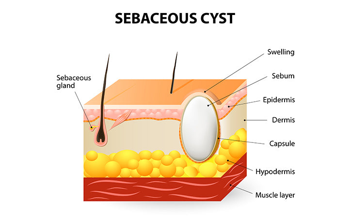 schematic illustration of a segment of skin with sebaceous cyst