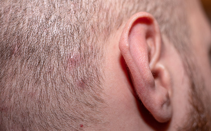 side view with ear in shot of a man with short hair suffering from scalp acne