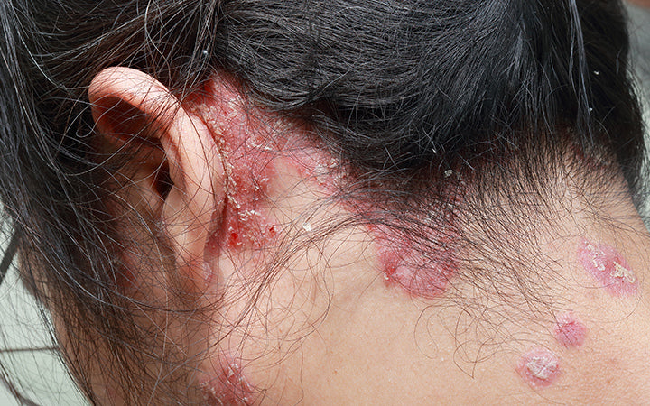 skin diseases psoriasis dermatitis
