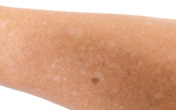 small white spots on arms idiopathic