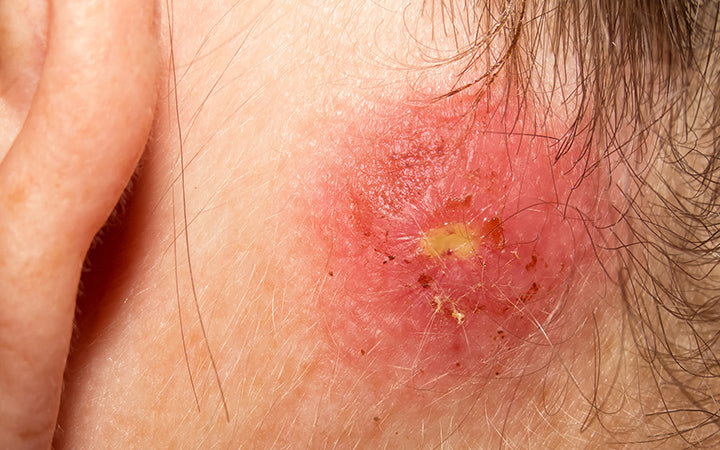 staph infection behind ear on woman