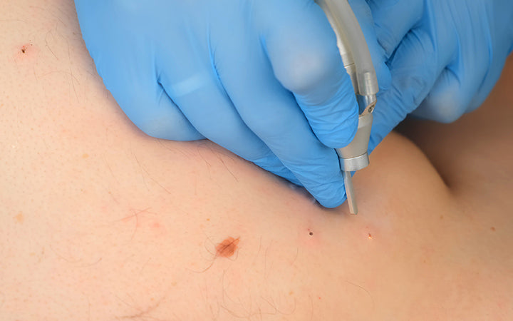 surgeon removing many small moles