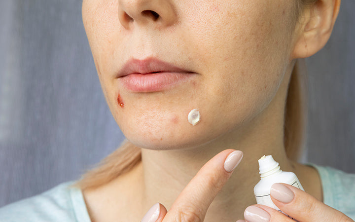 woman applying a healing cream to acne on her face