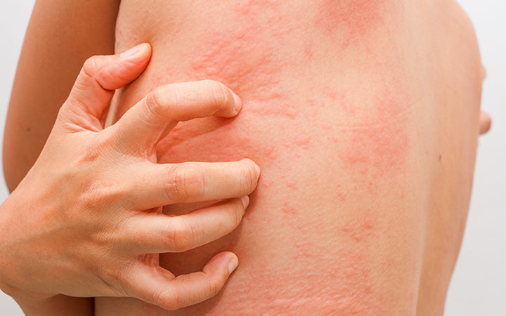 women with symptoms of itchy urticaria