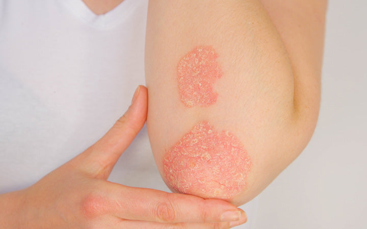 young woman suffering from skin disease called psoriasis
