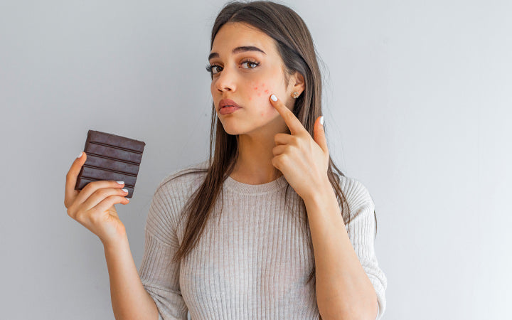 young woman with problem skin holding chocolate bar and looking at camera 