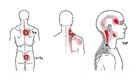 Janet Travell Trigger Points Functional Feet