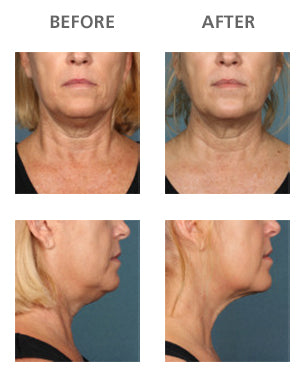 Unretouched photos of clinical trial patient taken before and after treatment with KYBELLA®.