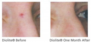 Diolite® Laser