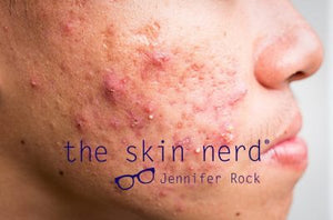 Identifying Cystic Acne Vs Other Types Of Acne The Skin Nerd Blog