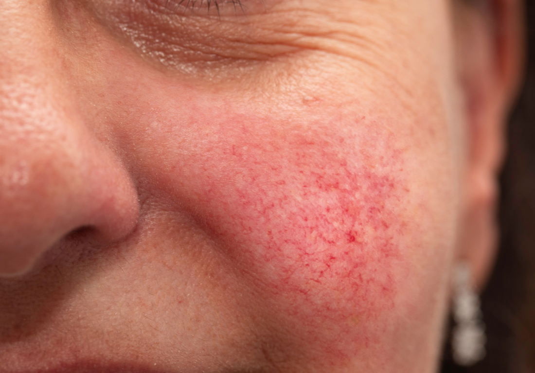 New Hampshire Rosacea Treatment