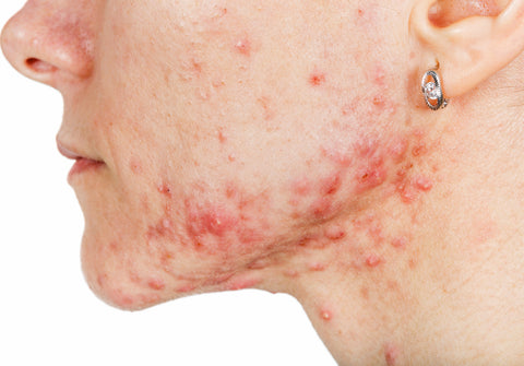 does diet affect acne