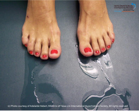 Treat hyperhidrosis of the feet by iontophoresis