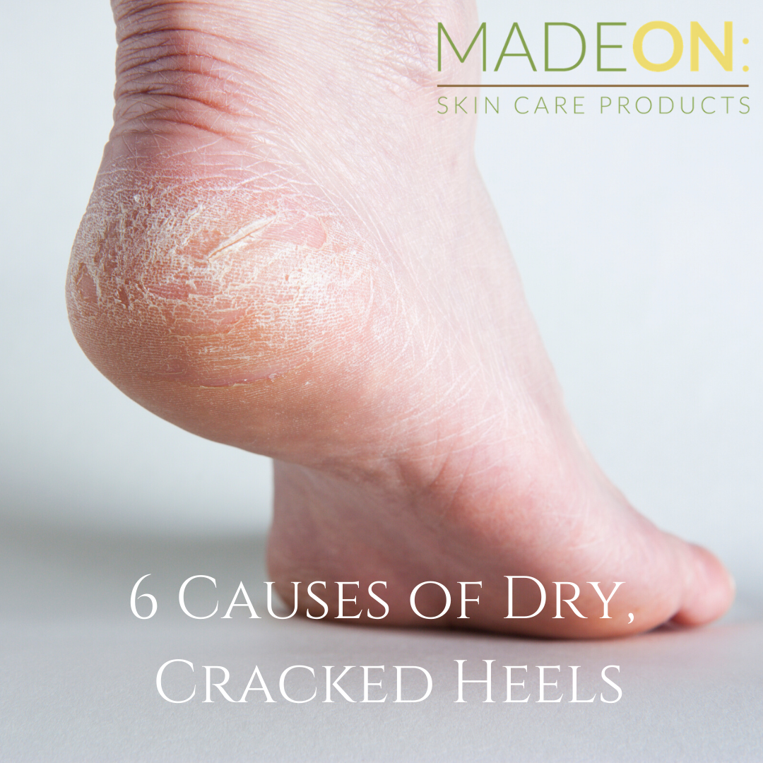 Natural Remedy & Treatment for Cracked Heels Symptoms