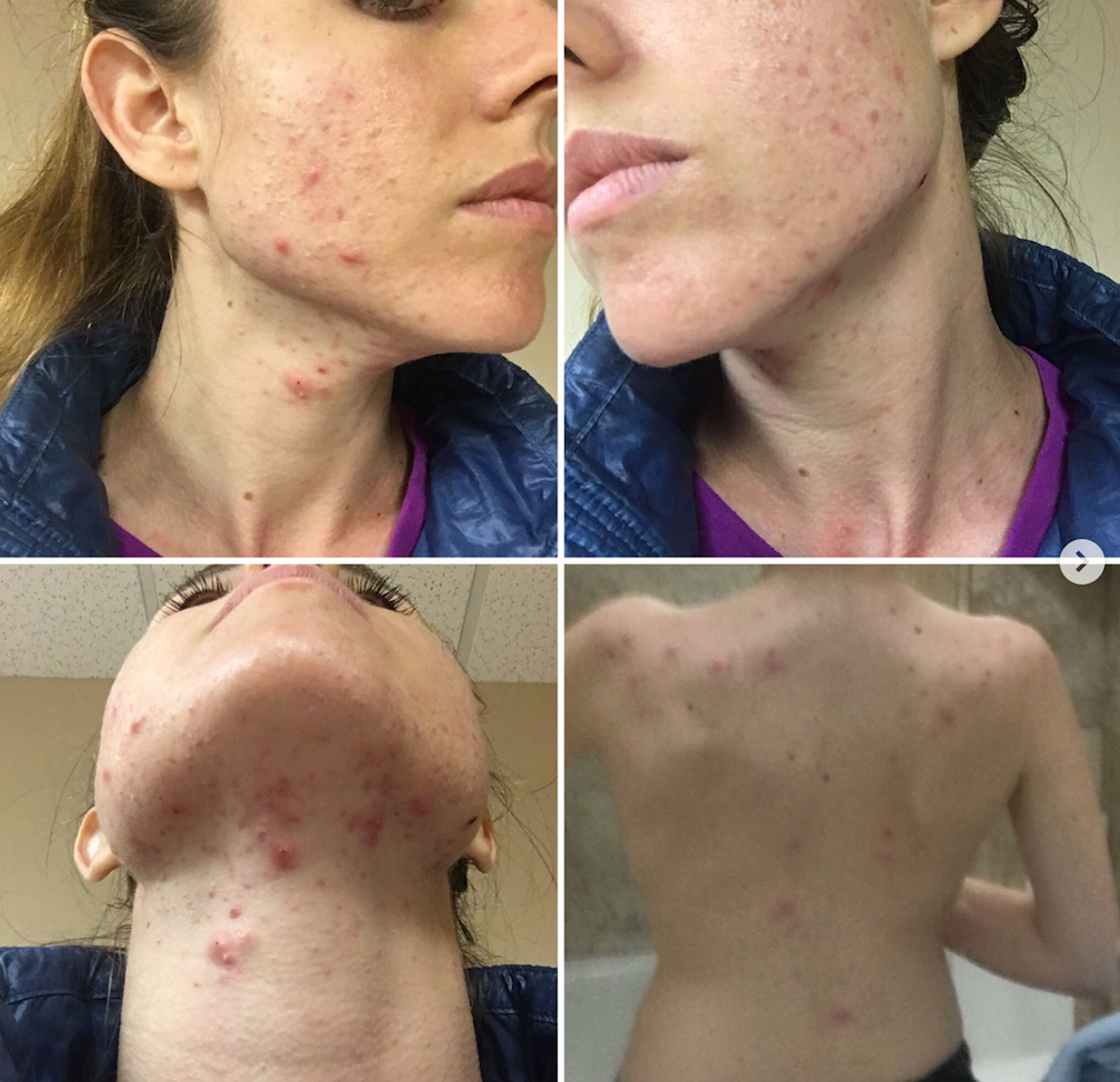 dani ferguson cystic acne