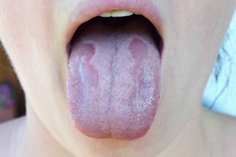A persons tongue showing the effects of antibiotics | HealthMasters