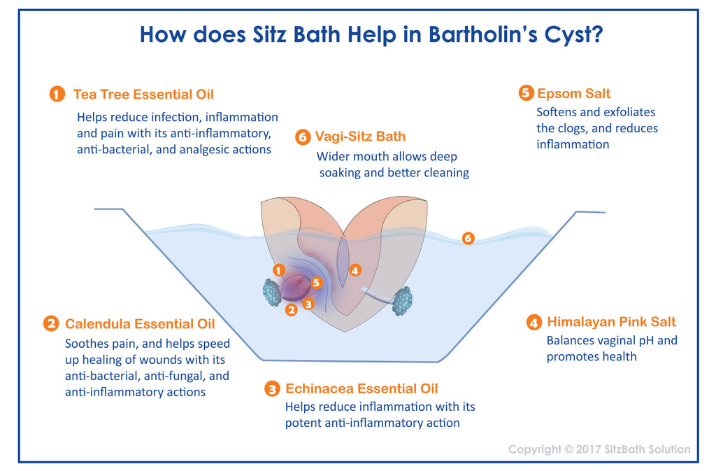 Sitz Bath Solution for Treatment of Bartholin Gland Cyst