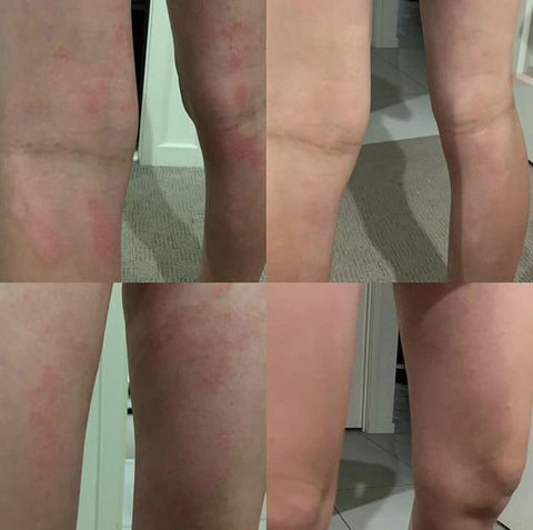 Before and after of psoriasis