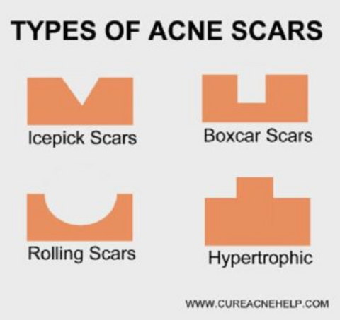 Types of Acne Scars