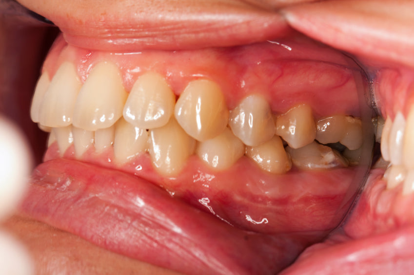 Sinus Infection Symptoms Gums