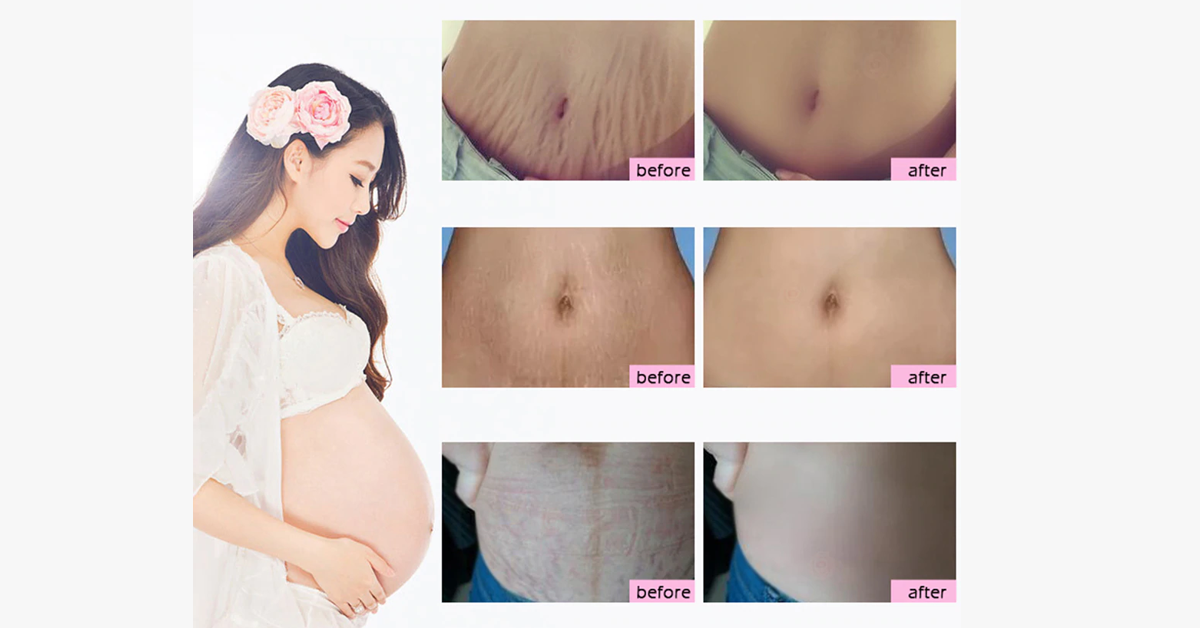 Pregnancy Scars and Stretch Mark Removal Cream - Free Ship Deals