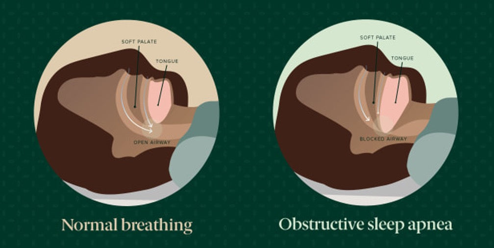 obstructive sleep apnea (osa) illustration