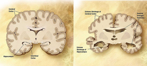 When our brains shrink, hippocampal and coronal areas of the brain along with the vesicle areas become larger and we lose brain volume | Health Direct USA