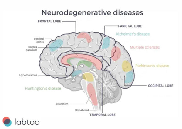 Health Direct | Brain Areas Affected By Different Neurodegenerative Diseases