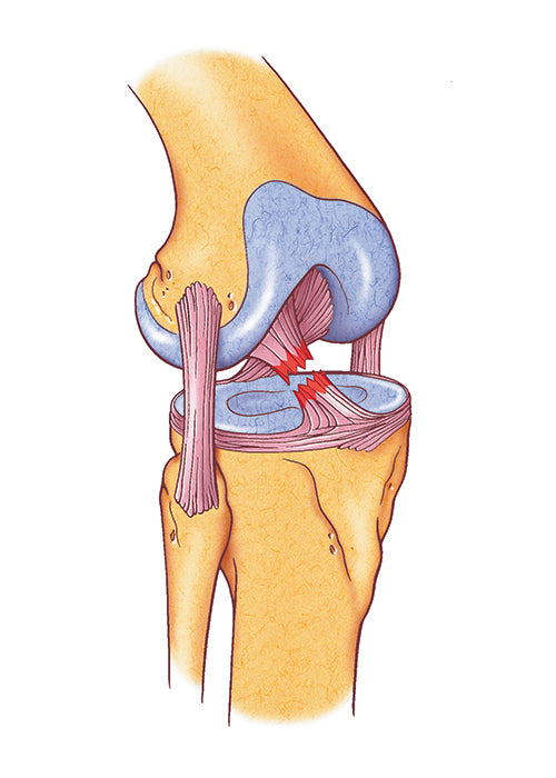 ACL INJURIES ILLUSTRATION