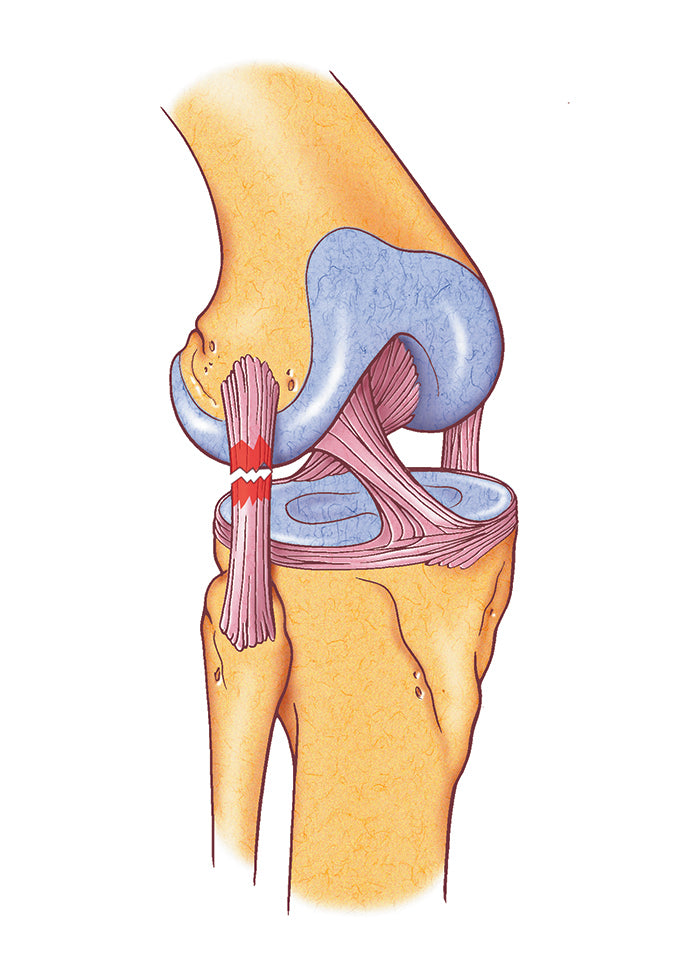 LCL INJURY ILLUSTRATION