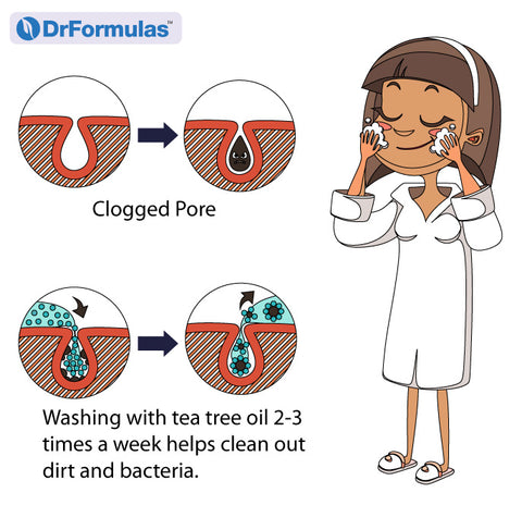 How Effective is Tea Tree Oil for Treating Acne?