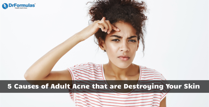 5 Causes of Adult Acne that are Destroying Your Skin