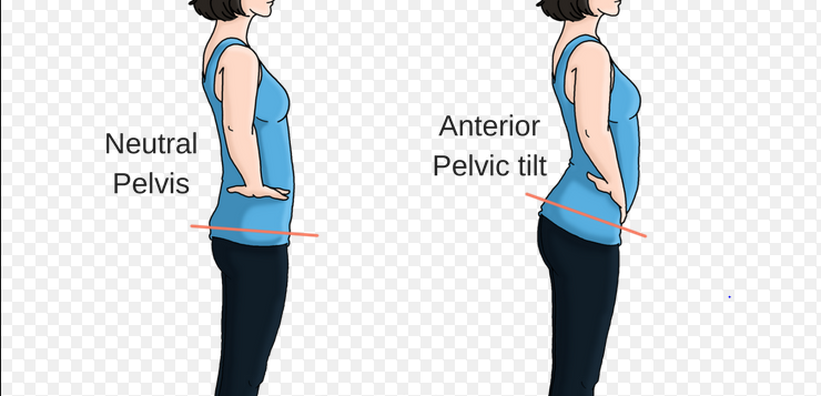 The Anterior Pelvic Tilt Beathardflaccid 