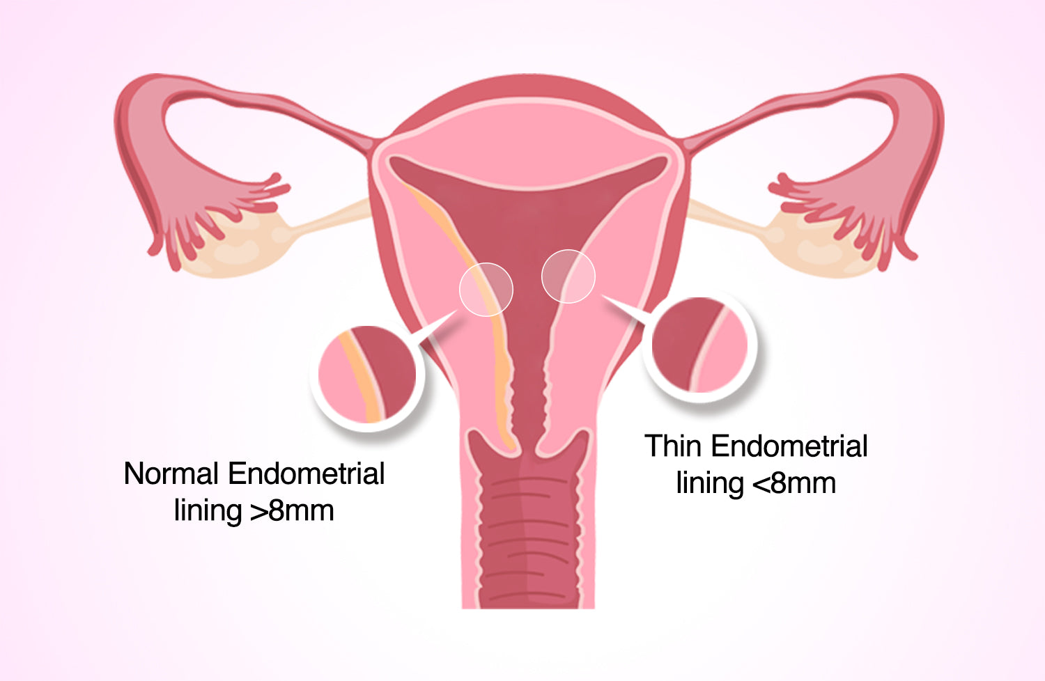 Hormonal IUDs and What They Mean For Your Endometrial Lining
