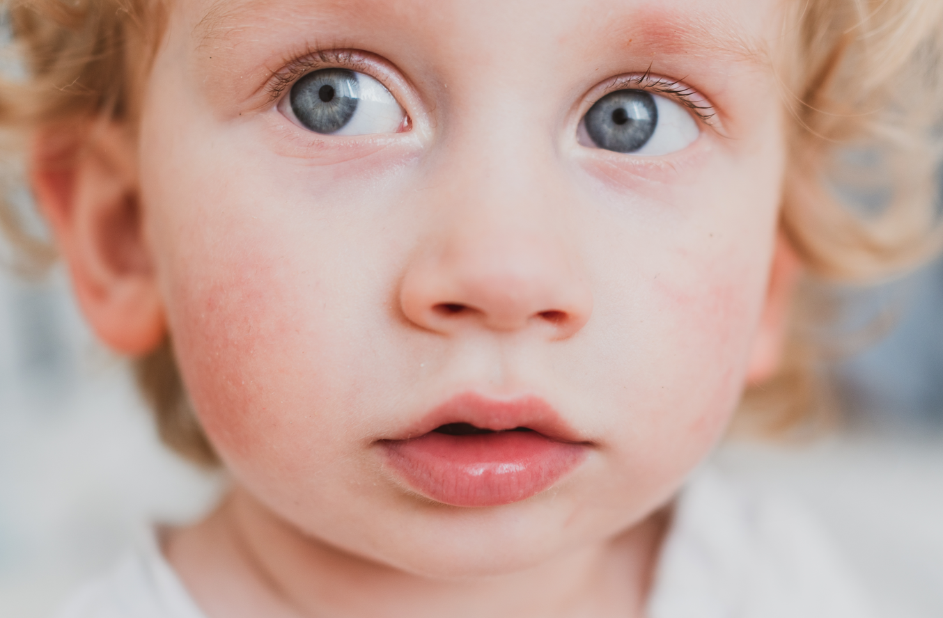 A zoomed in image of a baby with rosy pink cheeks. Pink cheeks are a common symptom of slapped cheek syndrome or fifth disease.