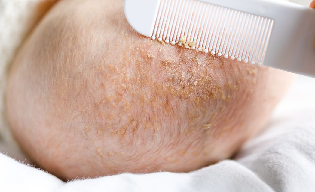 A parent combing baby's cradle cap scalp with a comb and removing flakes. 