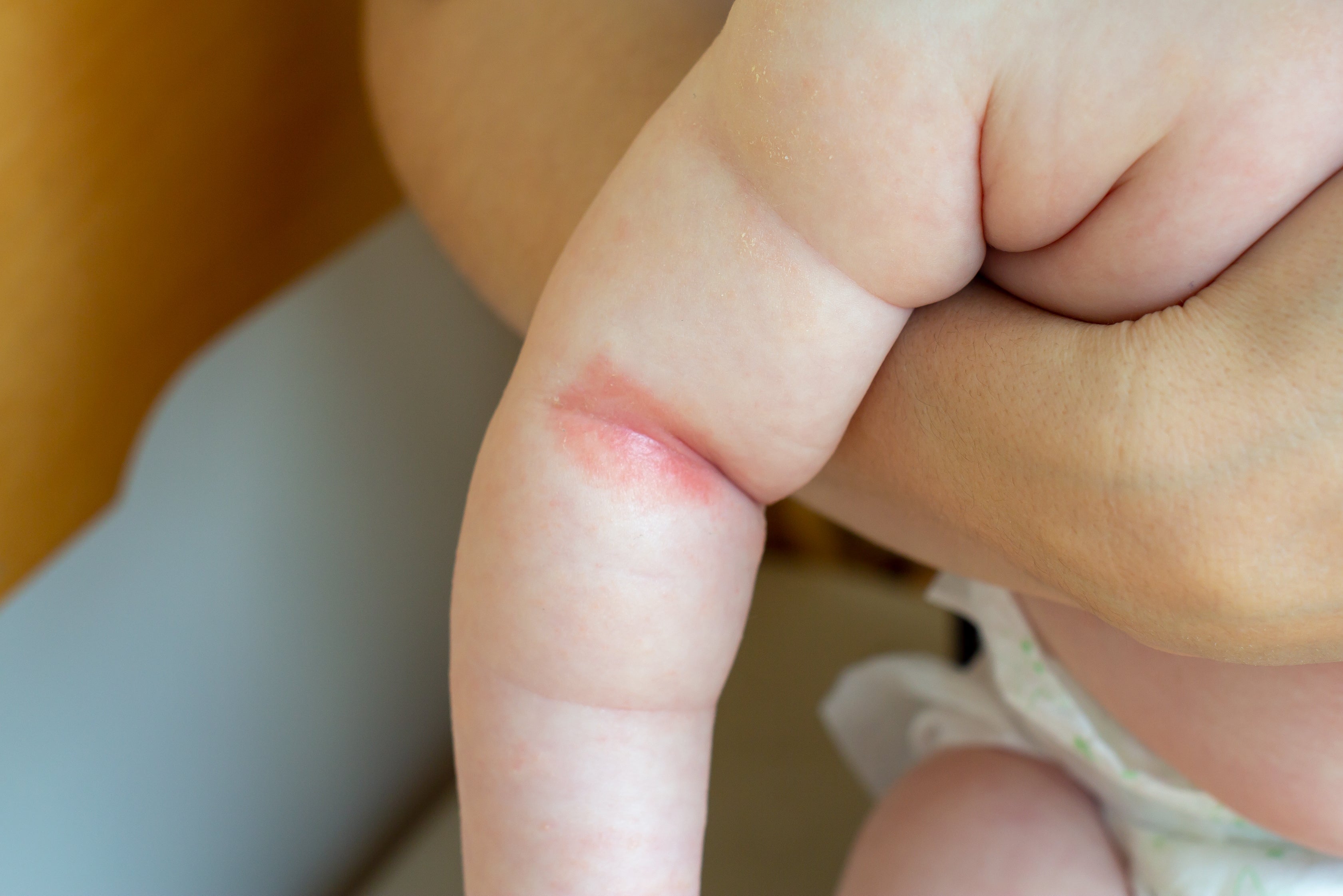 Reddish patch of prickly heat or heat rash or miliaria seen in the skin fold of a baby's arm 