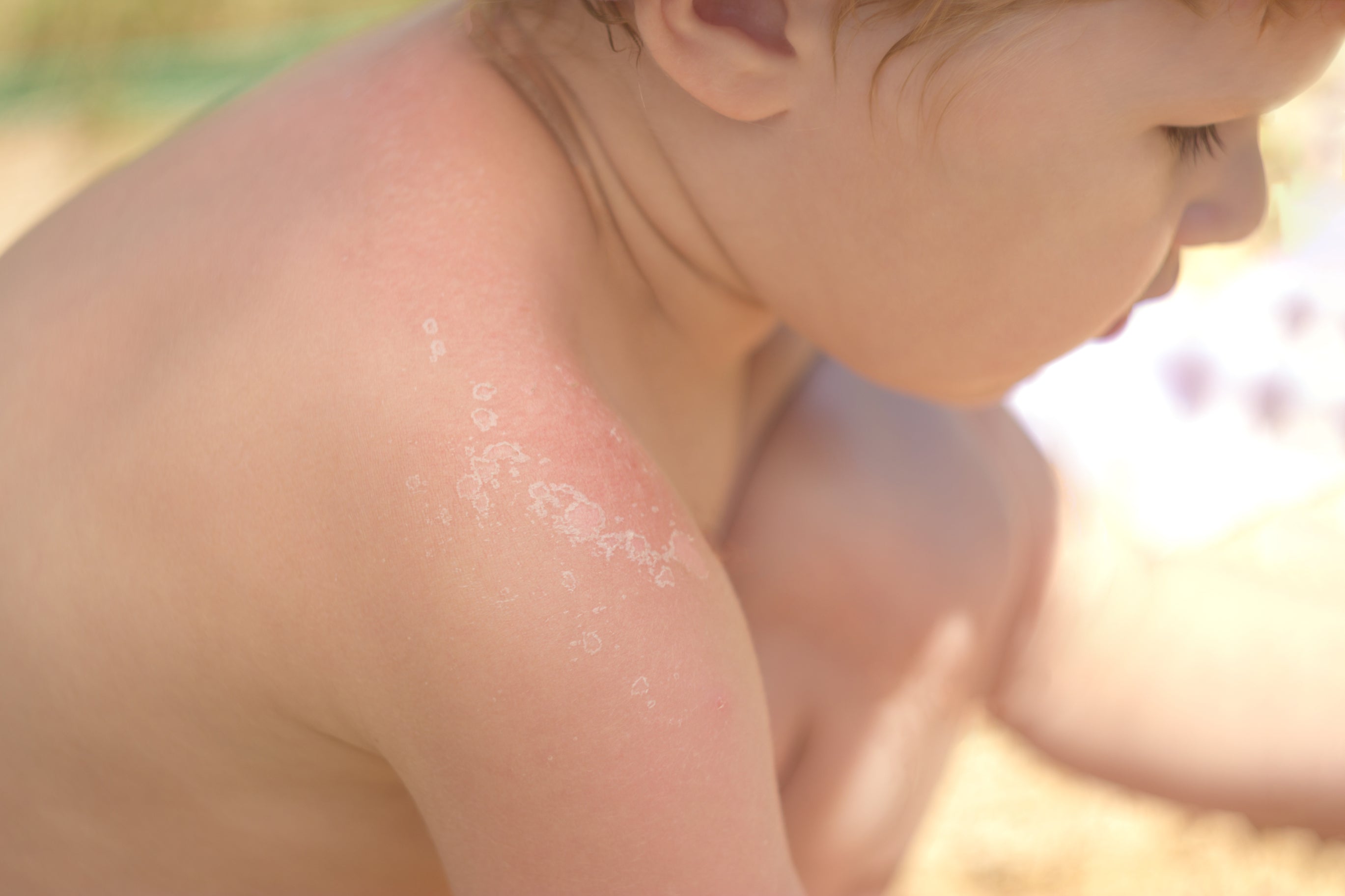 A toddler with a sunburn on his shoulder that is peeling. Shea butter can provide relief to sunburned skin in babies and children.