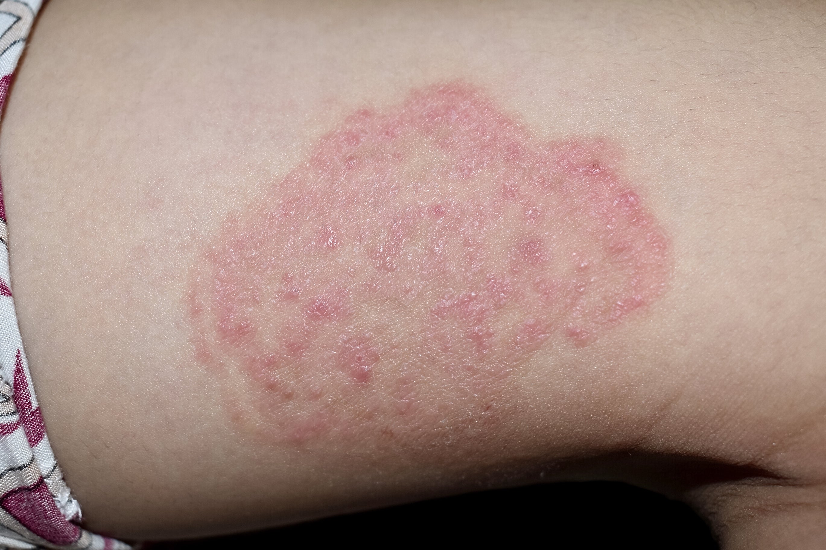 A ringworm rash seen on a baby's thigh 
