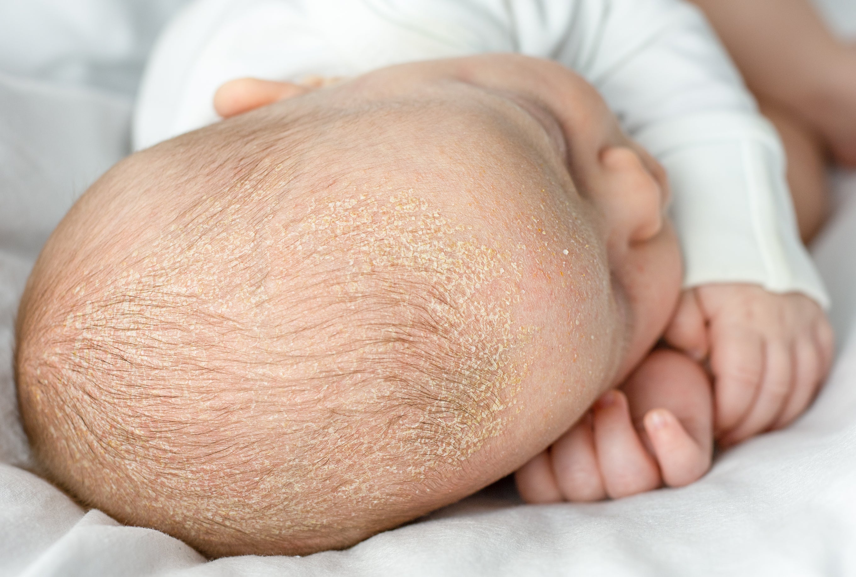 A newborn baby with cradle cap lying on a bed. Coconut oil can help loosen cradle cap flakes.