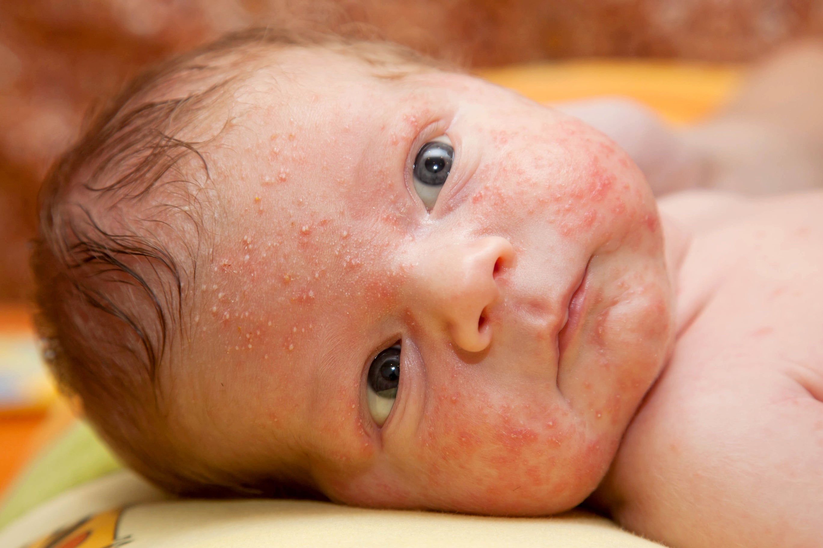 A newborn baby with neonatal acne on the face. Coconut oil can help with this common skin condition.