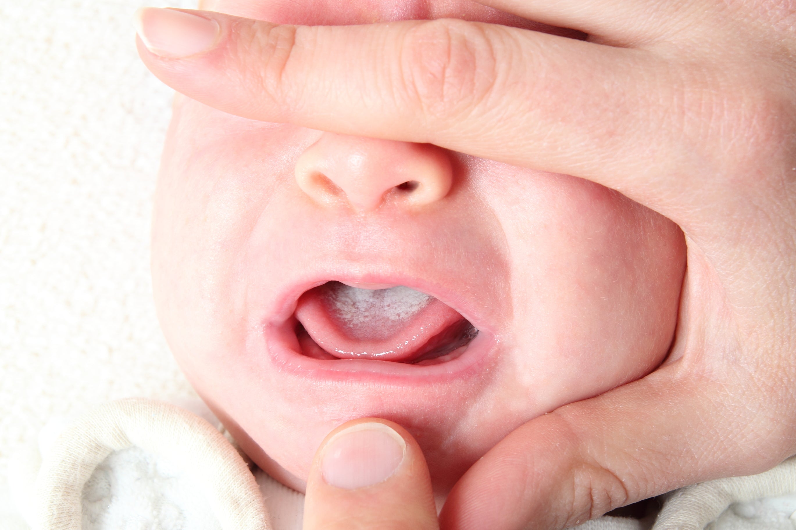 A newborn baby's face held by a hand, with oral thrush visible on the tongue. 