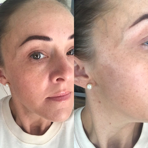 Skincare Before and After