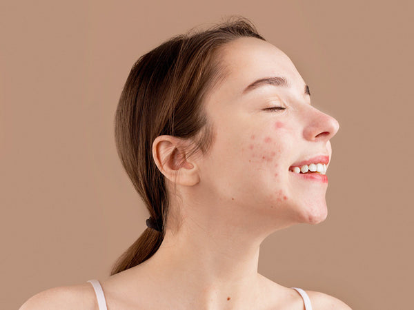 Skincare for teen skin