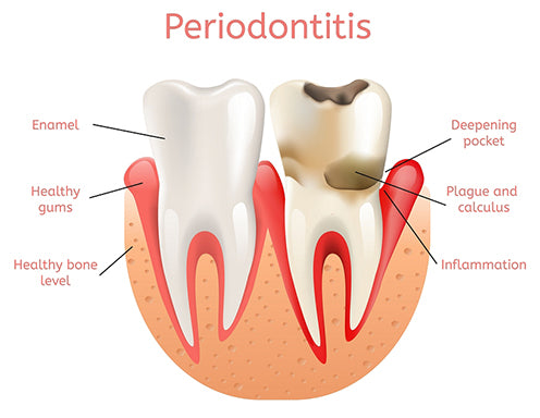 Periodontitis Inflammation