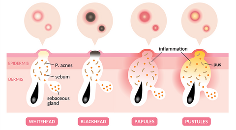 Progression of Acne Formation on Facial Skin 